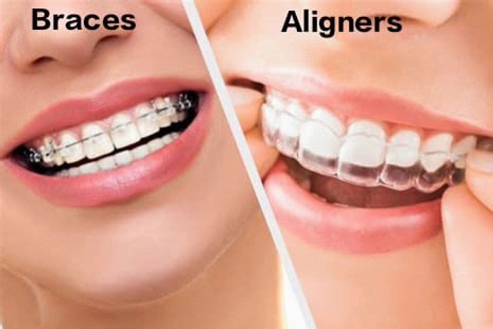 https://vitaldentalclinic.com/wp-content/uploads/2025/09/Braces-aligner1.jpg