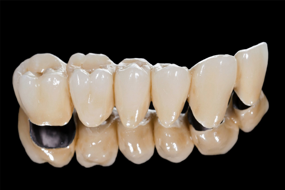 https://vitaldentalclinic.com/wp-content/uploads/2025/09/Crown-and-bridge-image.jpg