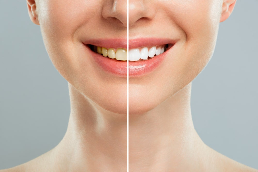 https://vitaldentalclinic.com/wp-content/uploads/2025/09/woman-teeth-before-after-whitening-white-background-dental-clinic-patient-image-symbolizes-oral-care-dentistry-stomatology-min.jpg